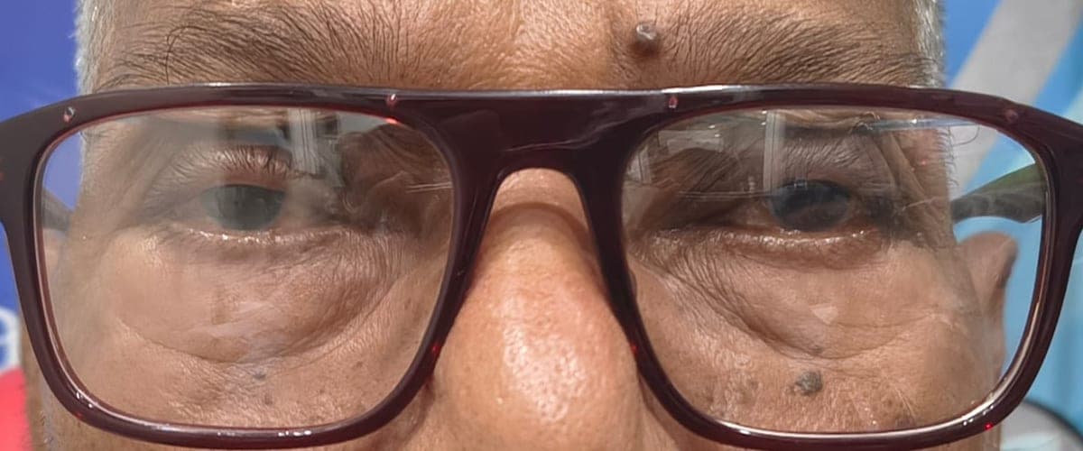 After: wearing crutch glasses, both eyes are open.