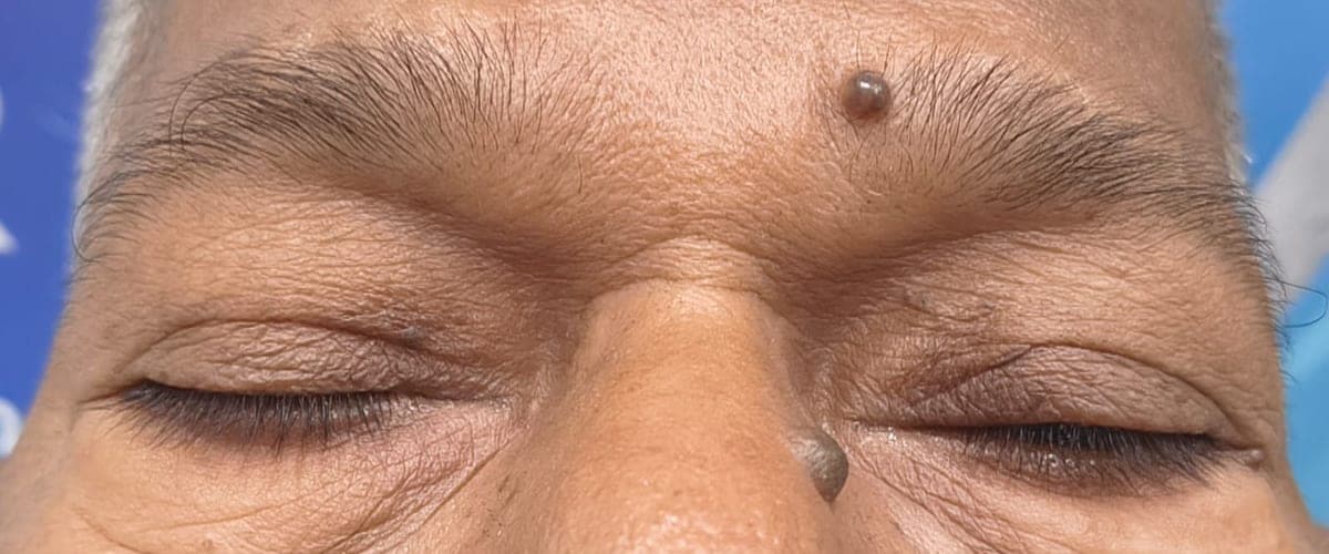 Before: both upper eyelids droop and cover most of the eyes.